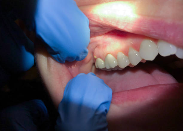 Best Dentist for Tooth Abscess  in Emerald Lakes, PA